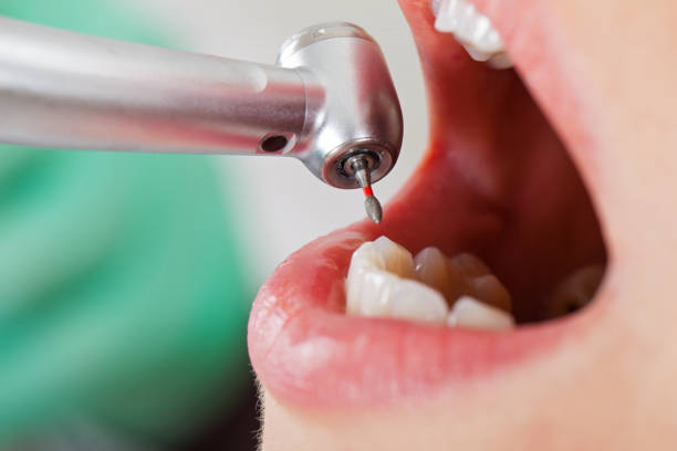 Best Emergency Root Canal Treatment in Orchards, WA